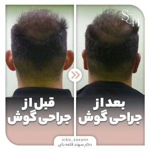 otoplasty-2