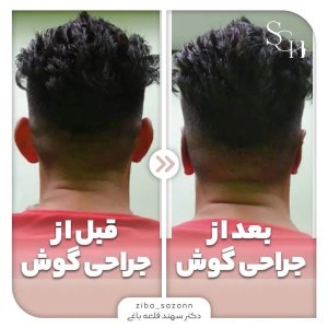 otoplasty-3