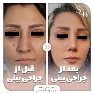 rhinoplasty-11