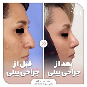 rhinoplasty-12