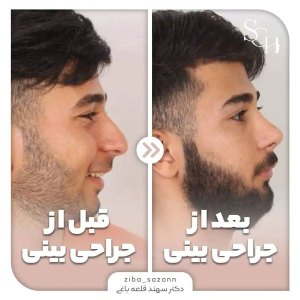 rhinoplasty-14