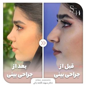 rhinoplasty-15