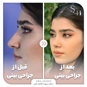 rhinoplasty-16