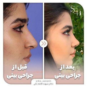 rhinoplasty-17