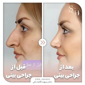 rhinoplasty-18