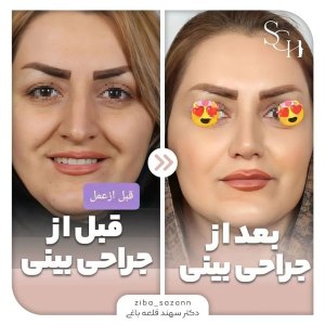 rhinoplasty-19