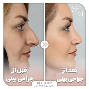 rhinoplasty-20