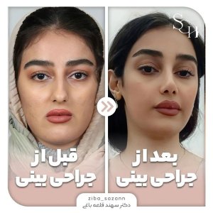 rhinoplasty-21
