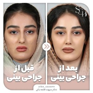 rhinoplasty-22
