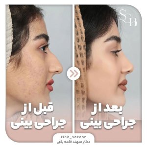 rhinoplasty-23