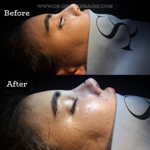 rhinoplasty-54