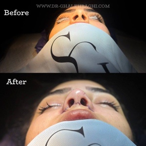 rhinoplasty-55