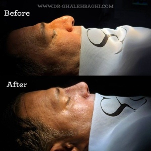 rhinoplasty-56