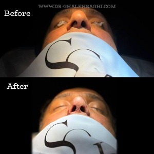rhinoplasty-57