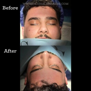 rhinoplasty-58