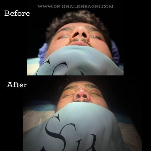 rhinoplasty-59