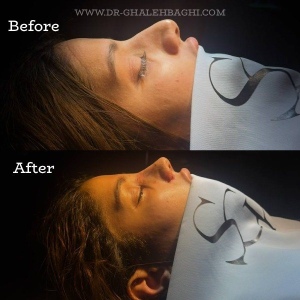 rhinoplasty-60
