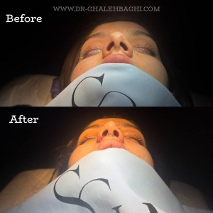 rhinoplasty-61