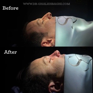 rhinoplasty-62