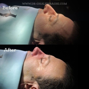rhinoplasty-63