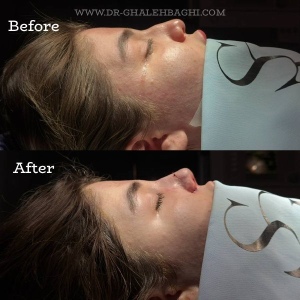 rhinoplasty-64