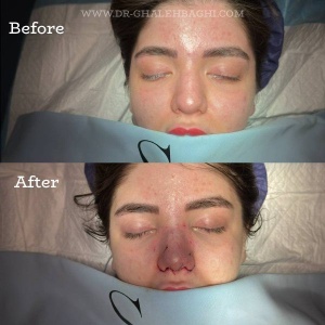rhinoplasty-65