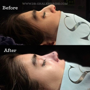 rhinoplasty-66