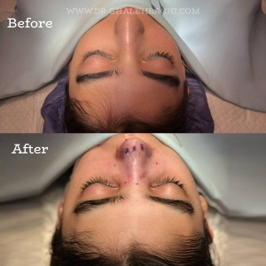 rhinoplasty-67