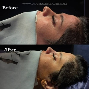 rhinoplasty-68