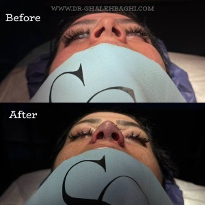 rhinoplasty-69