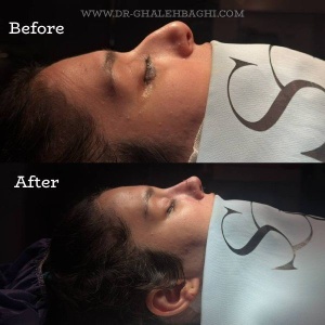 rhinoplasty-70