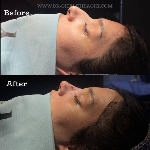 rhinoplasty-71