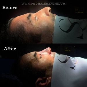 rhinoplasty-72