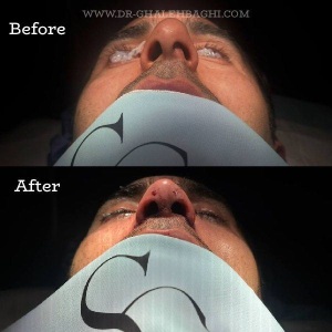 rhinoplasty-73
