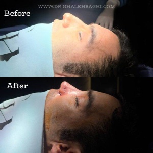 rhinoplasty-74