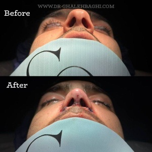 rhinoplasty-75