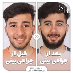 rhinoplasty13