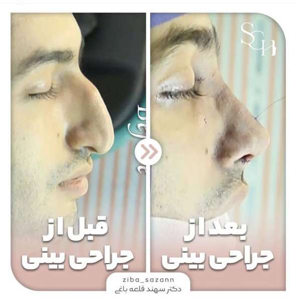 قبل و بعد از شکستگی بینی