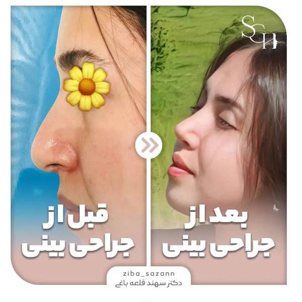عمل بینی نیمه فانتزی
