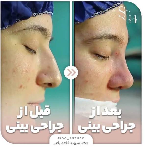 عمل بینی نیمه فانتزی
