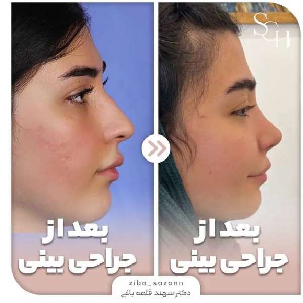 جراحی بینی فانتزی