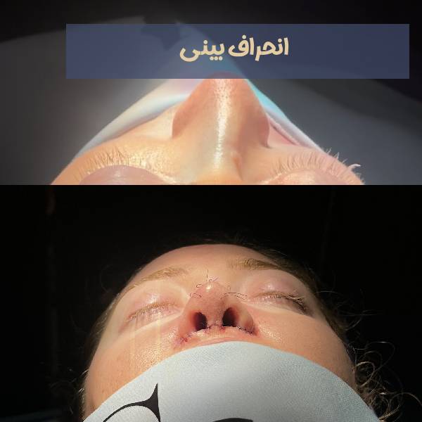 عکس انحراف بینی
