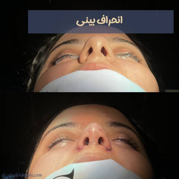 عکس انحراف بینی
