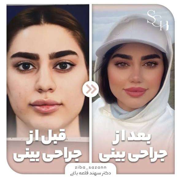 جراحی بینی طبیعی