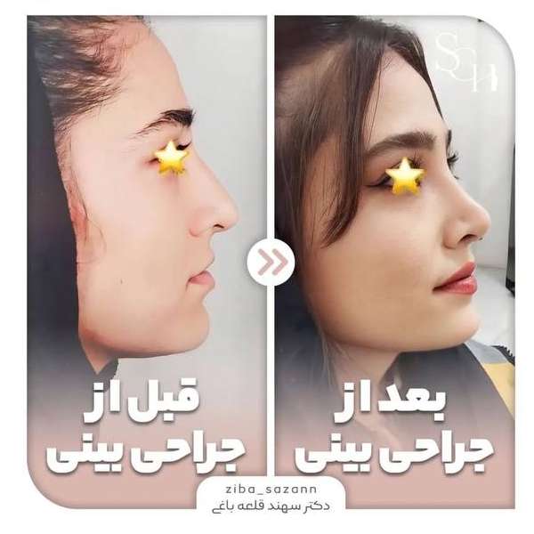 عکس بینی طبیعی عمل شده 