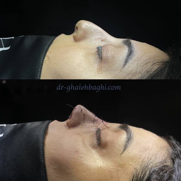 عکس جراحی بینی استخوانی