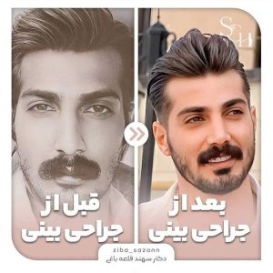عمل بینی مردانه