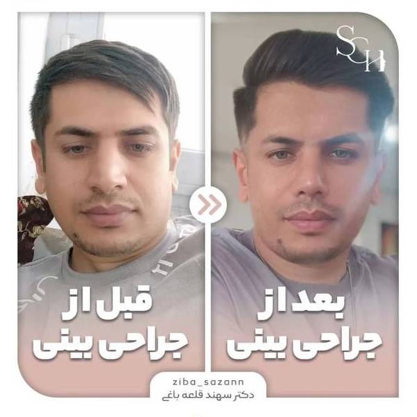 جراحی بینی مردانه