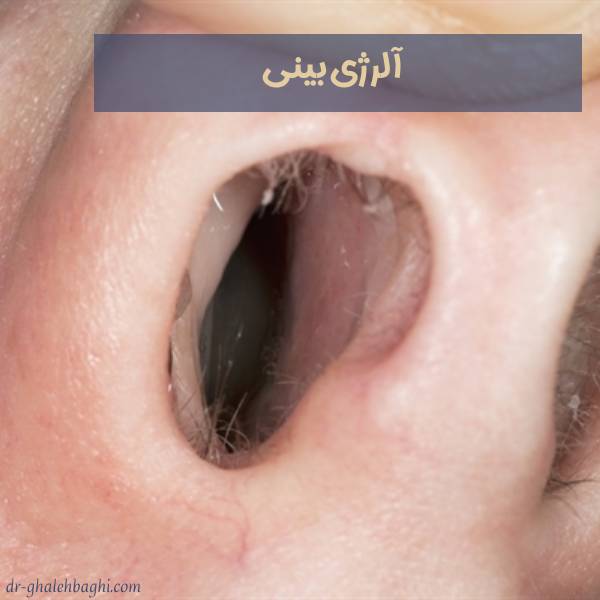 آلرژی بینی