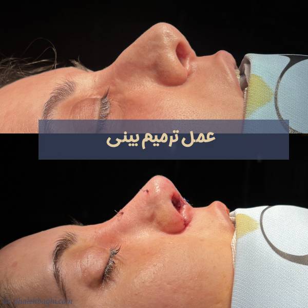 عکس عمل ترمیم شده بینی